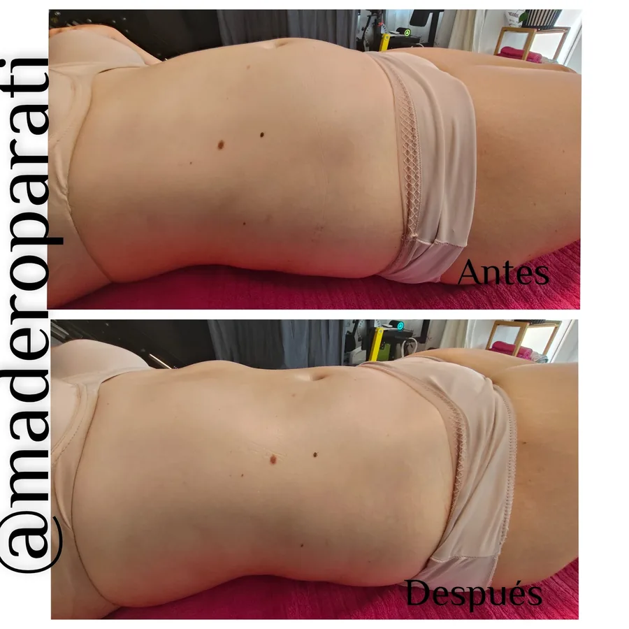 Antes y después de una sesión de drenaje en el abdomen